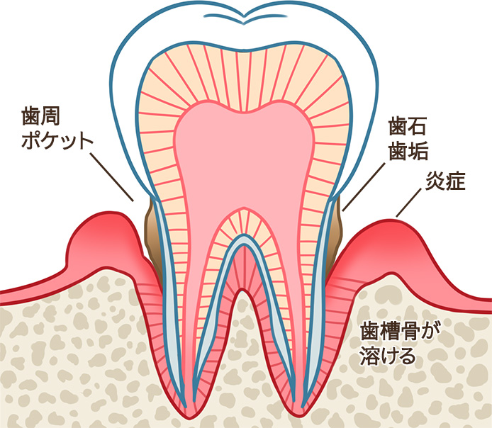 歯周病の状態イメージ